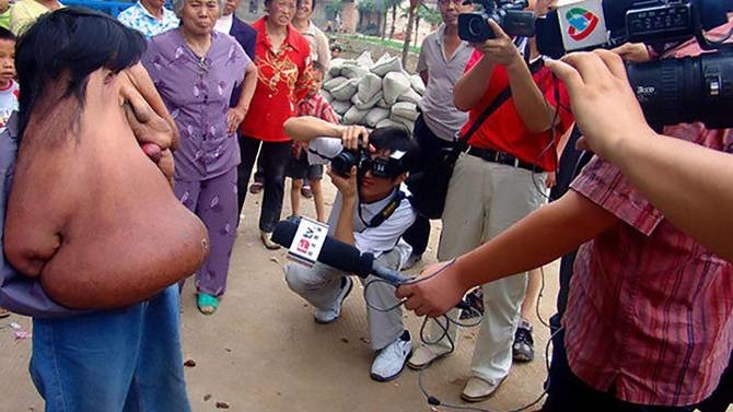 بالصور.. 39الرجل الفيل39 أصيب بأكبر ورم