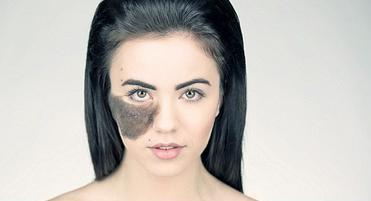 تتباهى بعاهتها وترفض التجميل