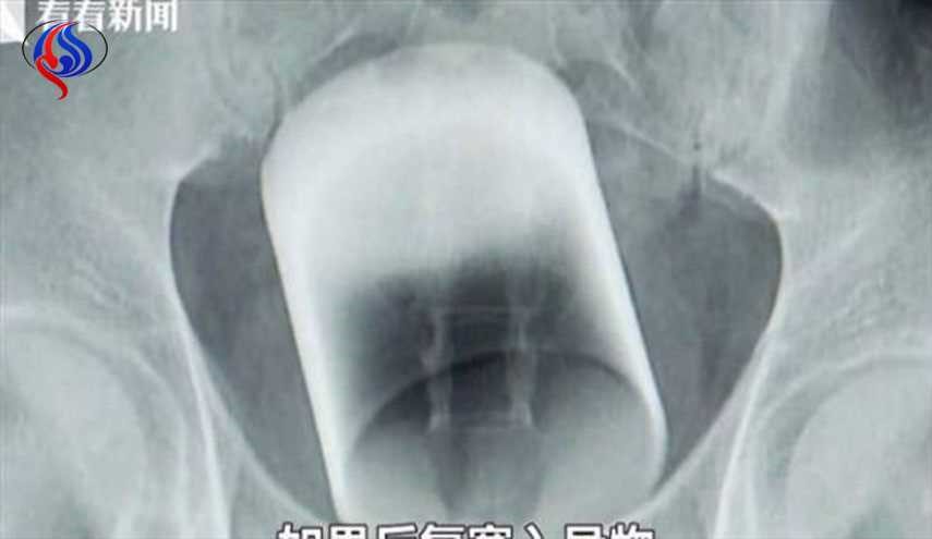 أطباء يكتشفون كأسا زجاجيا داخل أمعاء