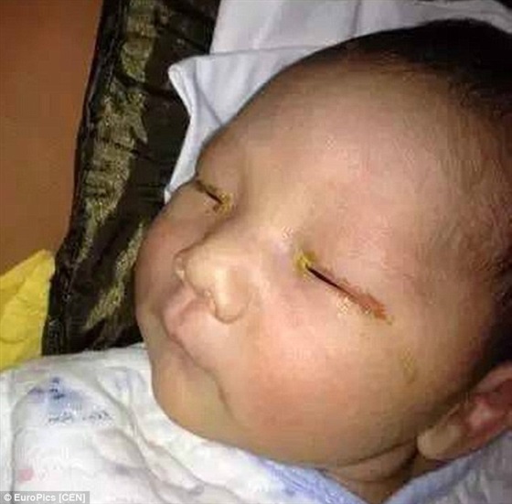 بالصورة.. رضيع يفقد بصره بسبب (فلاش