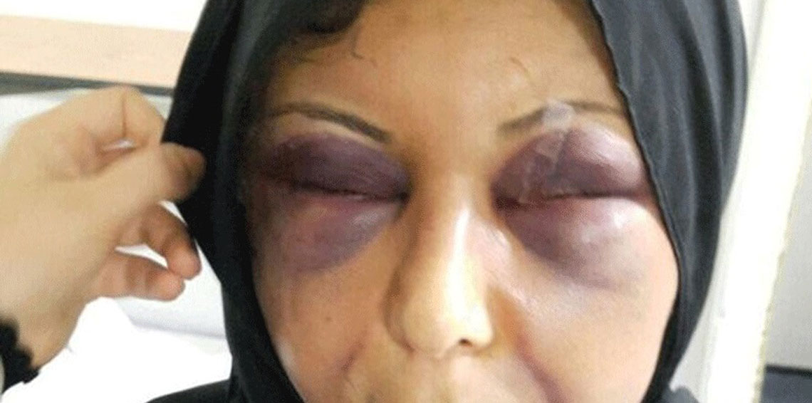 بحريني يعتدي بوحشية على زوجته السورية