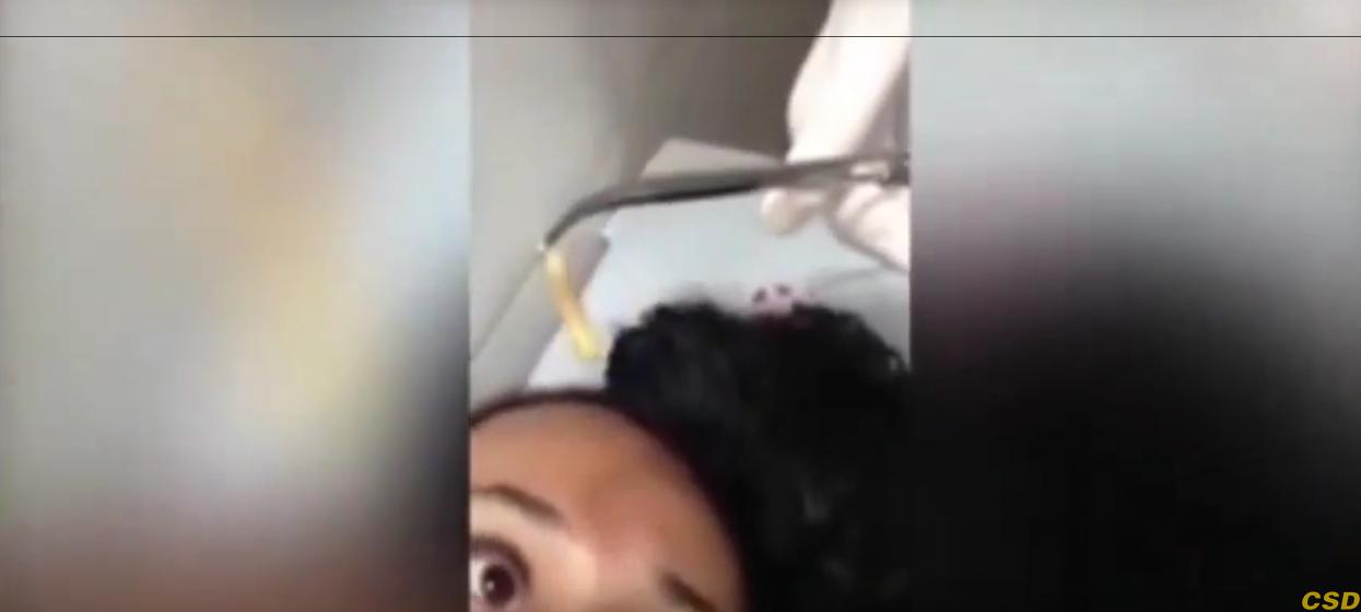بالفيديو: إزالة يرقة حية من داخل