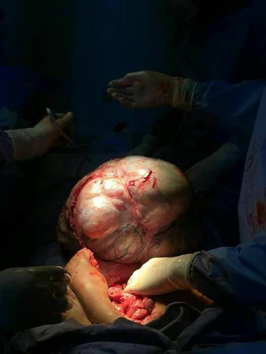 بالصور .. استئصال ورم وزنه (18)