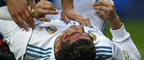 بالفيديو رونالدو يتعرض لإصابة دامية ويستعين