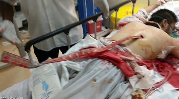 صورة: استخراج سيخ حديدي من ظهر