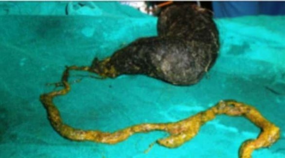 الهند: إزالة كرة شعر تزن 2.6