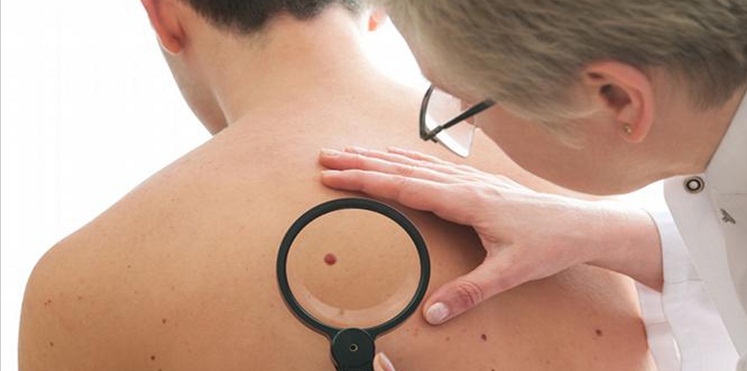 كيف تميز بين الشامة السرطانية والحميدة؟
