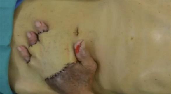 إعادة يد رجل عبر ربطها بجيب