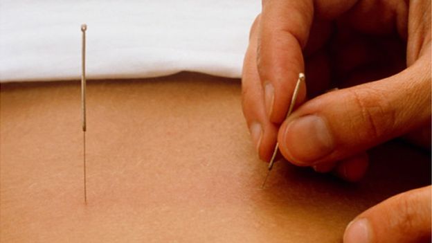 هل تخفف الإبر الصينية من ألم