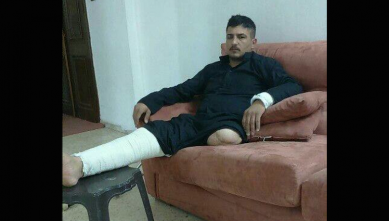 بعد بتر قدمه.. قائد ميداني في