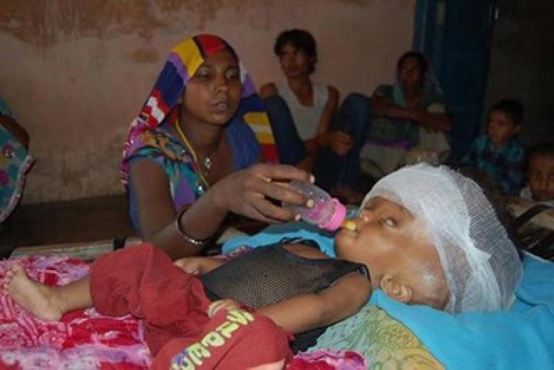 طفلة يتضاعف حجم رأسها 3 مرات