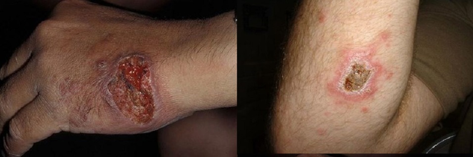 مرض جلدي نادر سيعجل بنهاية داعش