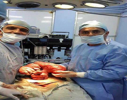 استئصال ورم بوزن 12 كيلو من