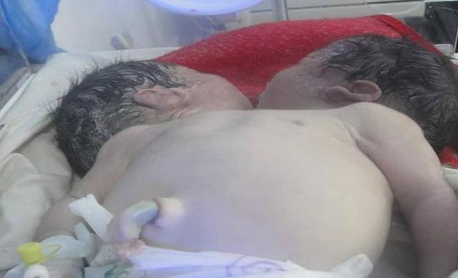ولادة طفل برأسين وقلب مشوه في