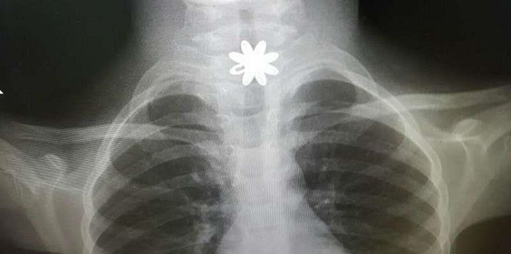 استخراج قطعة ذهب من مريء طفلة