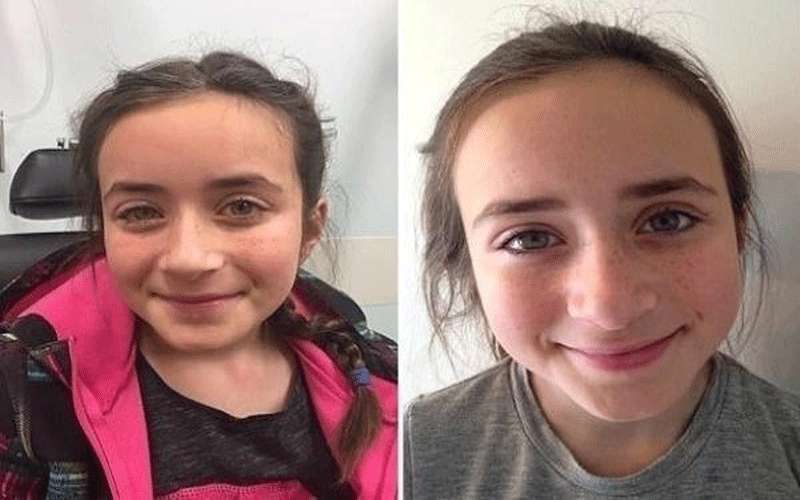 تفقد بصرها 4 أيام بسبب العدسات