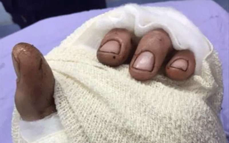 زراعة أصابع يد مبتورة بمدينة الحسين