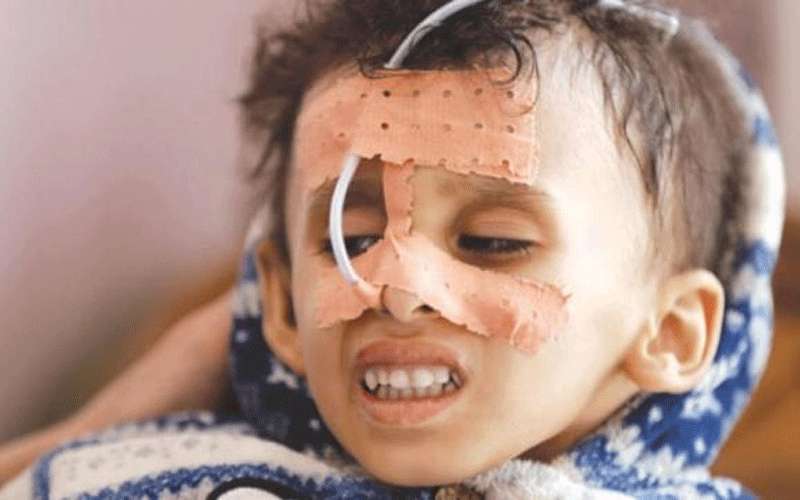 12 مليون يمني مهددون بمجاعة قاتلة