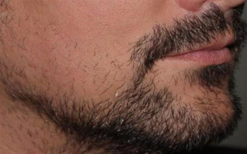 حلول لفراغات شعر الذقن