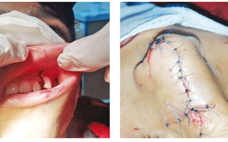 كلاب ضالة تشوه وجه طفل في