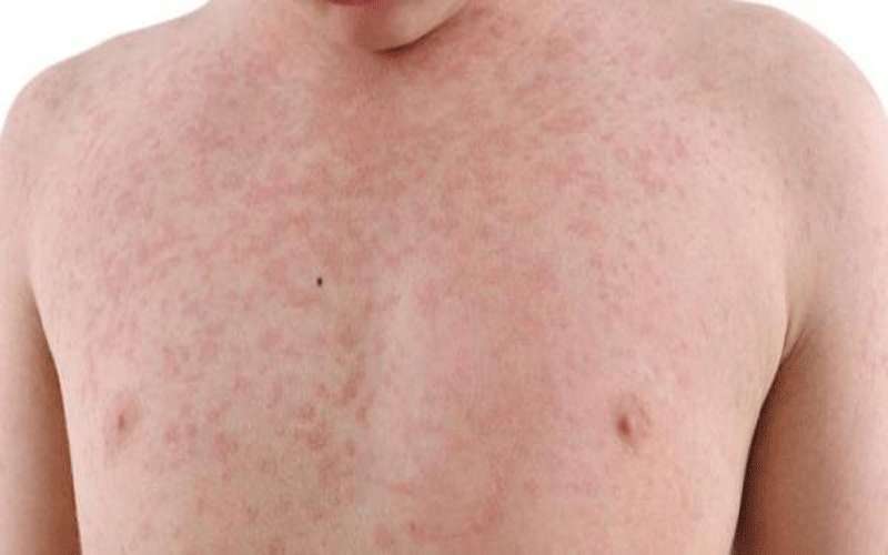 إكتشاف إصابات جديدة بالحصبة والصحة تناشد