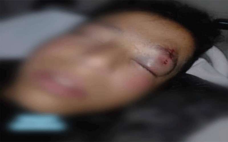 توقيف معلم ضرب طالبا وأصابه بعينه