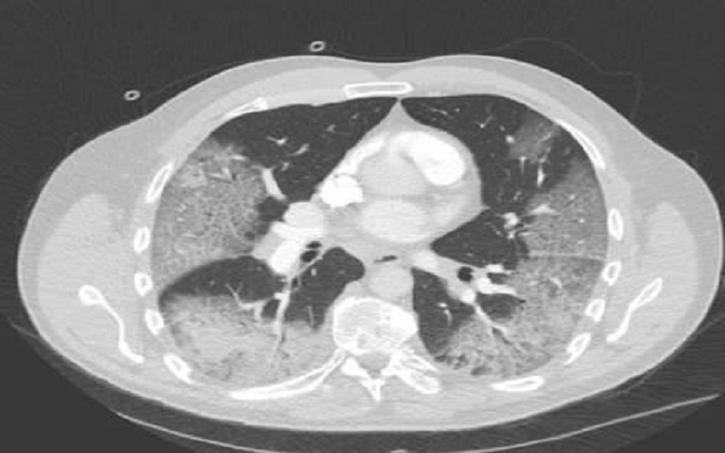 مدير الحسين للسرطان ينشر صورة لرئتي