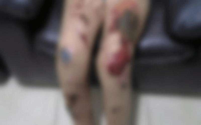 توقيف أب عذب وأحرق طفله بالأسيد