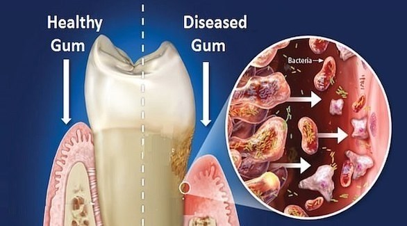 أمراض اللثة قد تزيد من خطورة