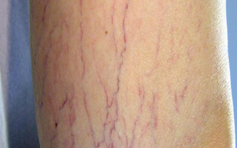 دوالي الساقين.. الأسباب والأعراض وطرق العلاج