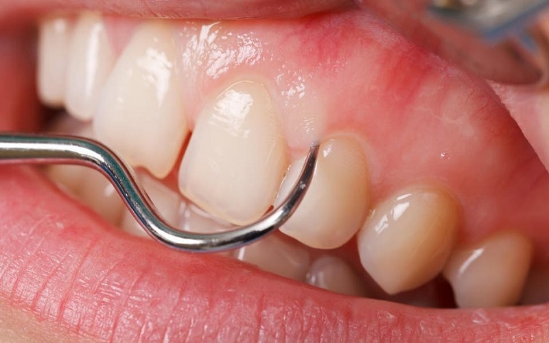 ماذا تعرف عن التهاب اللثة؟