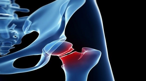 هل يمكن لأدوية هشاشة العظام أن