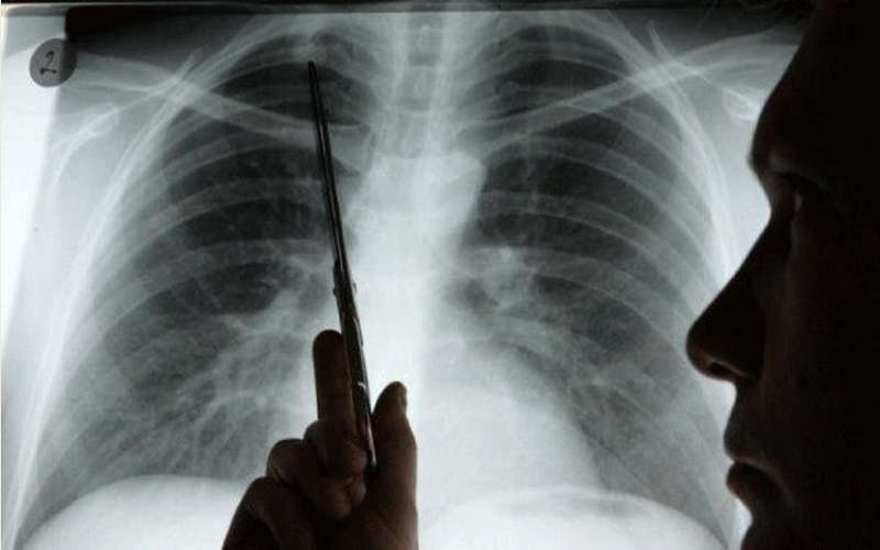 دراسة: كورونا قد يثقب رئة المريض