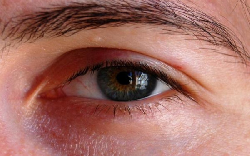 علاجات منزلية تهدئ من تهيج العين