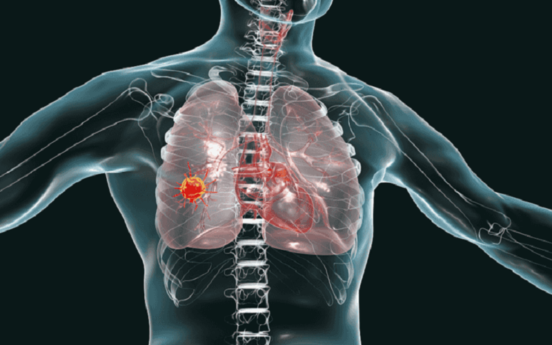 أطباء يحذرون من امتلاء رئات بعض