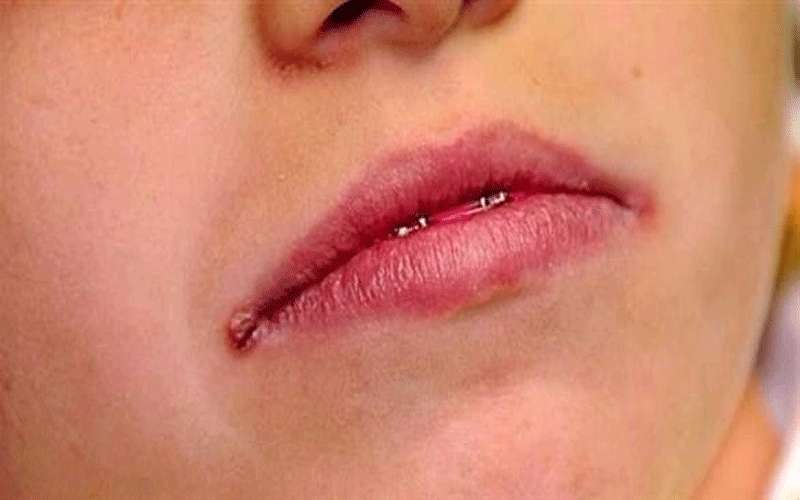 تشققات زوايا الفم تدل على إصابتك
