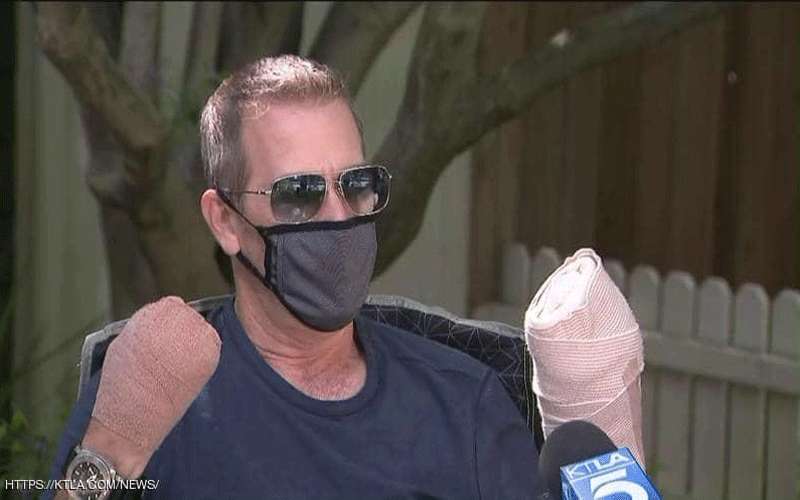 أميركي يفقد أصابعه بعد إصابته بكورونا