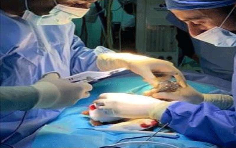 عملية نادرة لفصل توأم متلاصق في