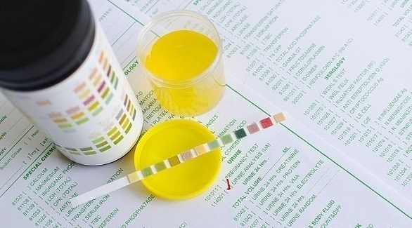 فحص بول يثبت نجاحا كبيرا في