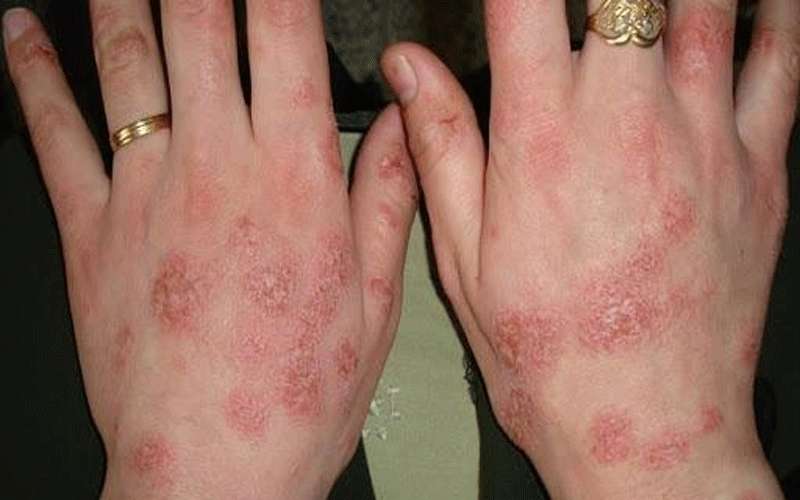 أمراض جلدية في فصل الشتاء.. الأسباب