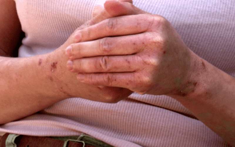 علاجات طبيعية وفعالة للأكزيما المزمنة