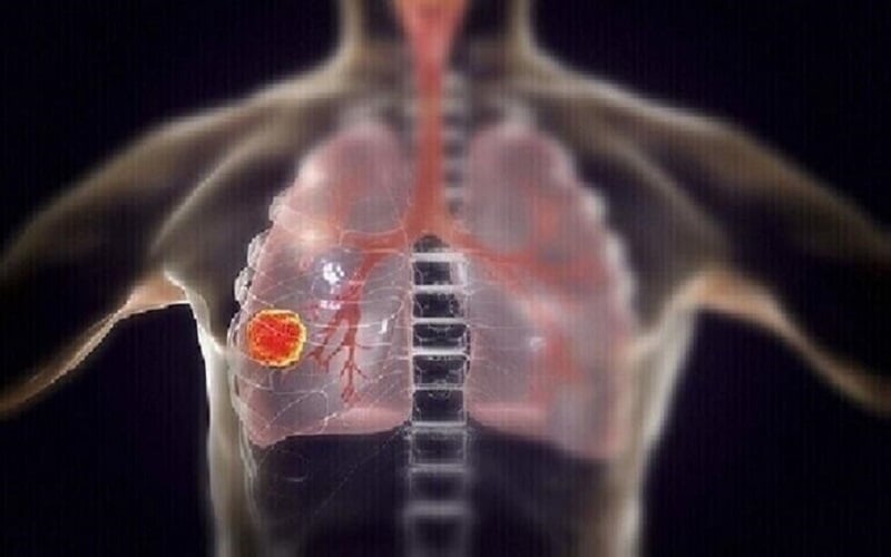 علامات تحذيرية لسرطان الرئة غالبا ما
