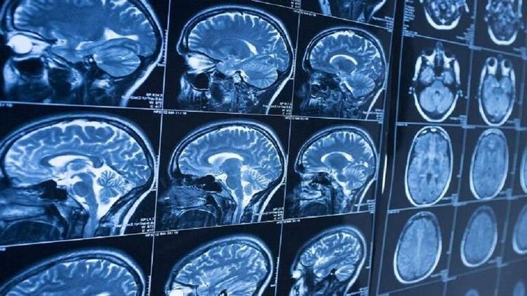 الكشف عن أولى علامات الخرف