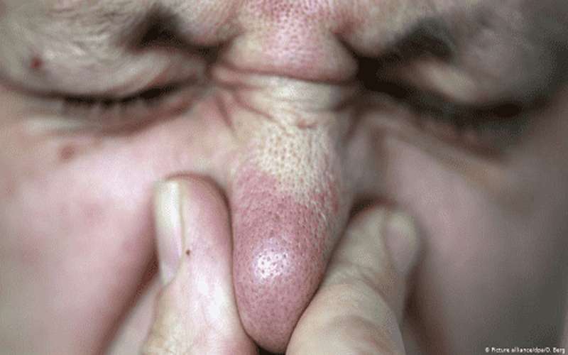 روائح غريبة يشمها المتعافون من كورونا