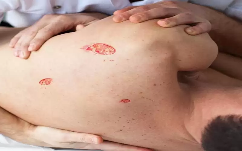 كيف نمنع تقرحات الفراش عند ذوي