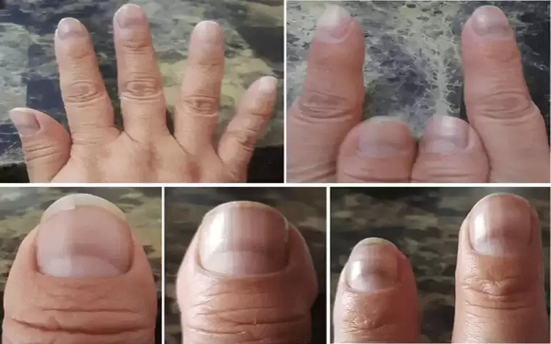 علامة على الأظافر تشير إلى الإصابة