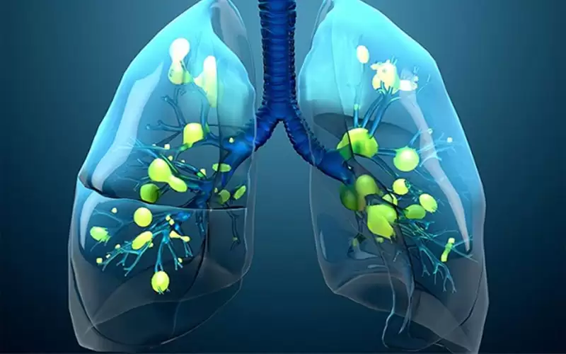 مرض التليف الكيسي.. أسبابه وأعراضه ومضاعفاته