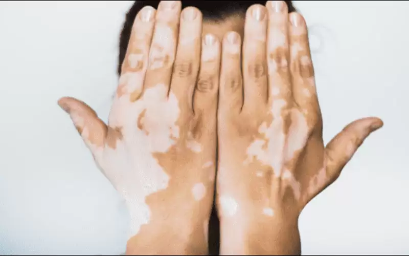 إذا كنت تعاني من البهاق فإياك