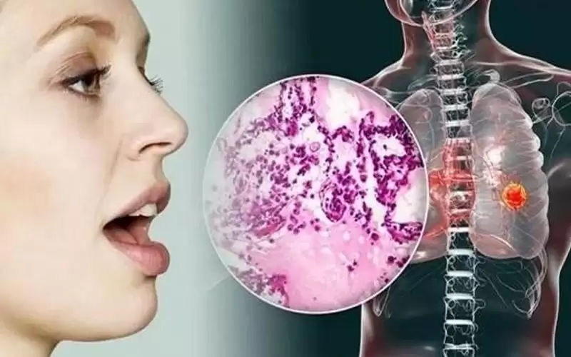 مؤشر في صوتك على الإصابة بسرطان