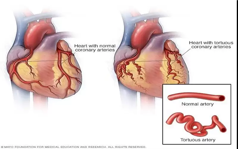 ما هي أمراض الشرايين التاجية وطرق